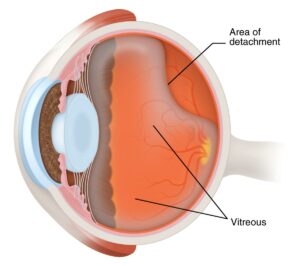 Area of Detachment & vitreous