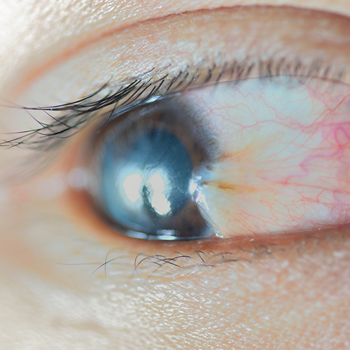 Close-up of Pterygium in an eye