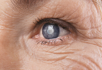 Closeup of an Eye With Cataracts