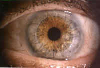 Cornea Transplant Example