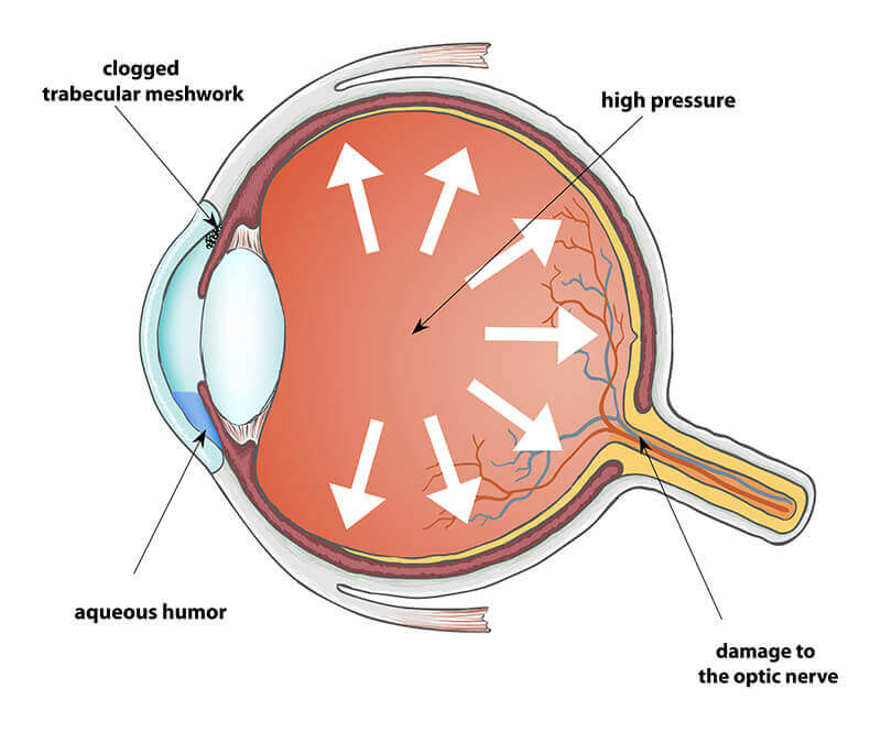 Glaucoma Diagram