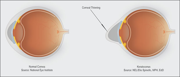 Keratoconus diagram