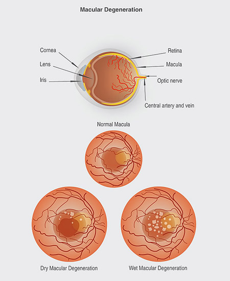 Macular Degeneration diagram