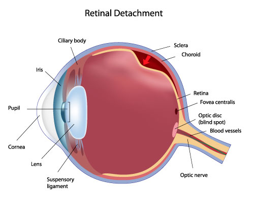 Retinal Detachment Diagram