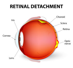 Retinal Detachment