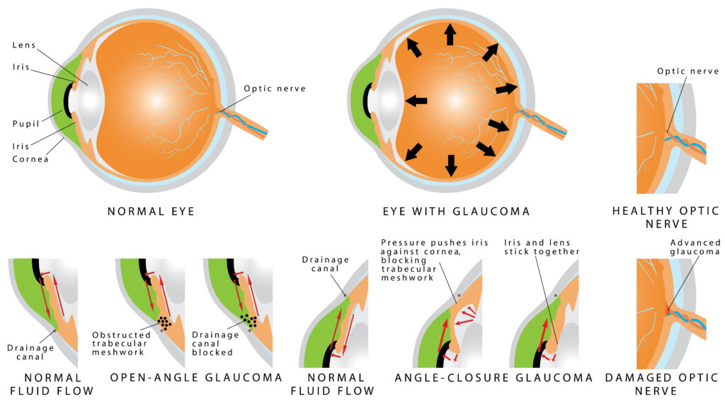 Normal Eye vs Eye with Glaucoma