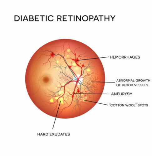 Diabetic Retinopathy Diagram