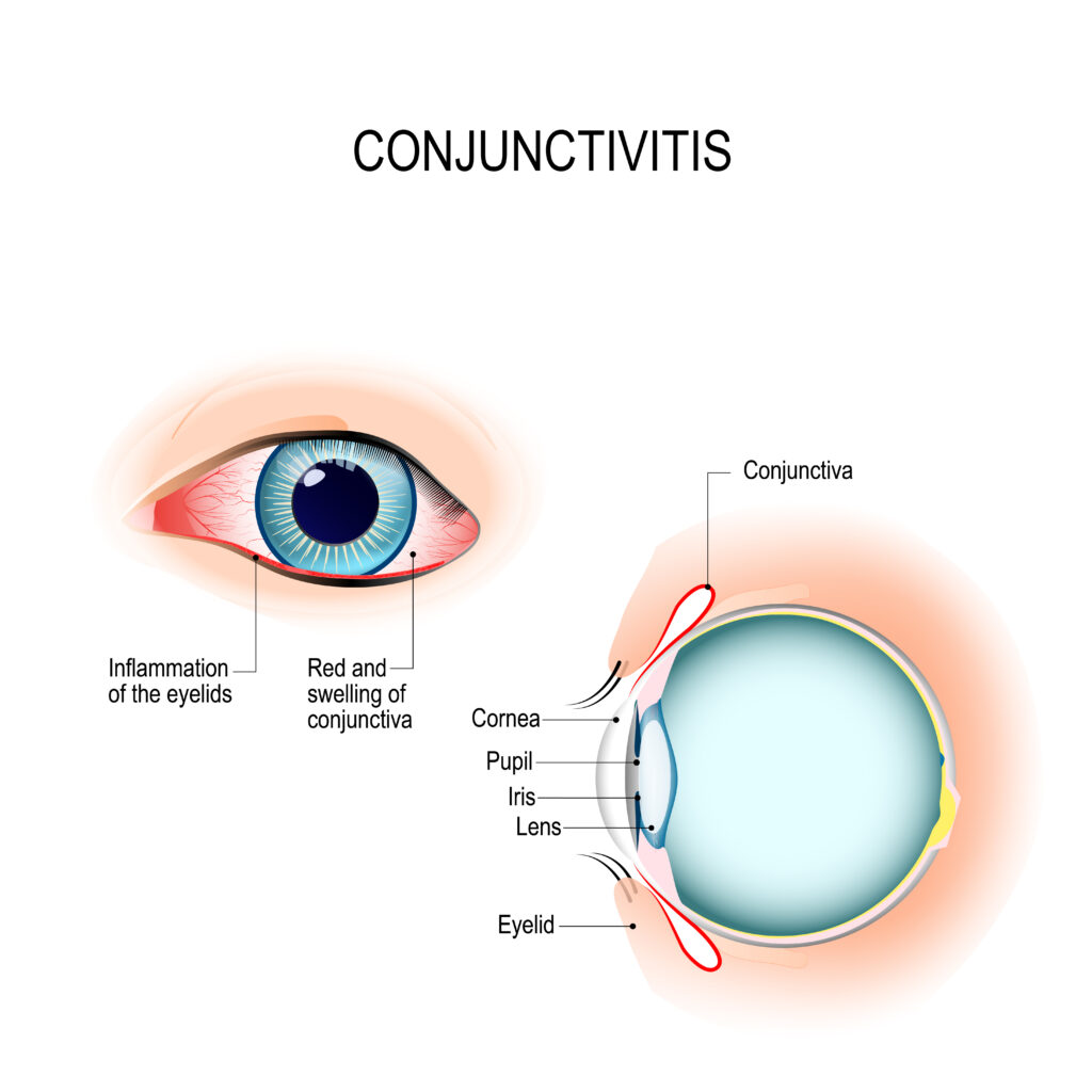 Conjunctivitis